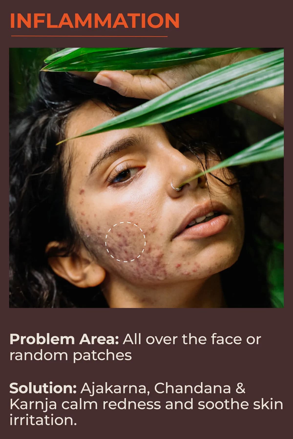 Inflammation: all over the face or random patches. Ajakarna, Chandana and Karnja calm redness